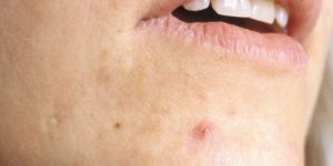 Symptoms of Cystic Acne