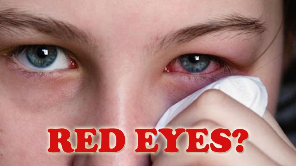 RED BLOODSHOT EYES OR RED EYES A Best Fashion