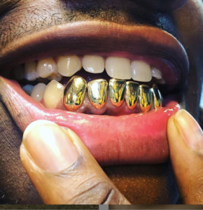 How Much Does Permanent Gold Teeth Cost? - A Best Fashion